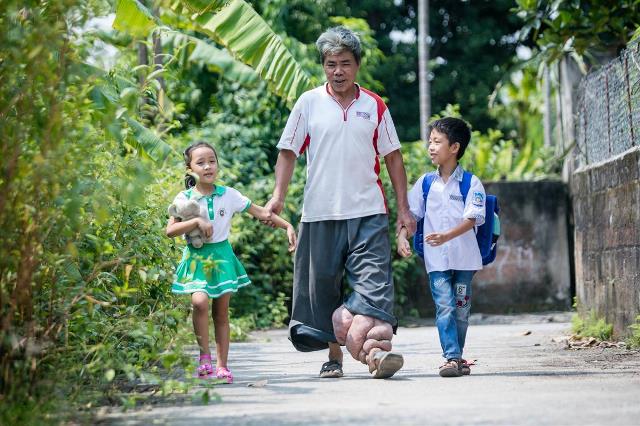 Lymphatic filariasis lymphatic_filariasis_re